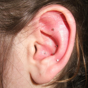 auriculothérapie avec ASP aiguilles semi-permanentes acupuncture oreille
