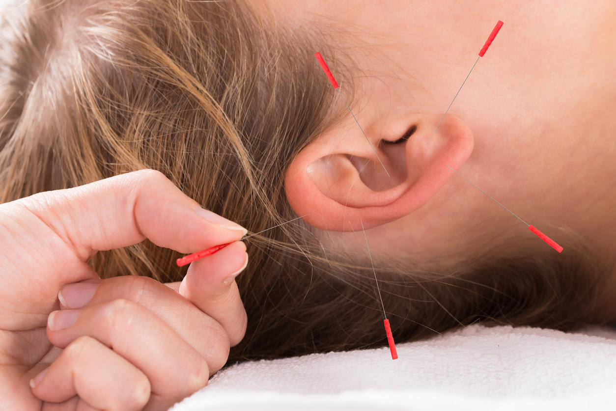 soulagement des acouphènes par l'acupuncture -bruit dans oreille