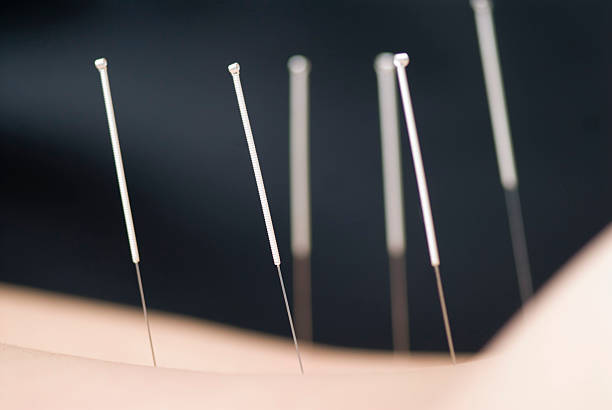 l'acupuncture une aide pour maigrir et perdre du poids