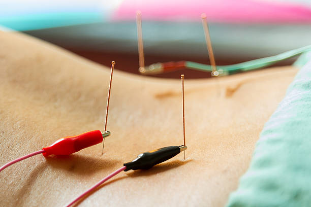electroacupuncture efficace douleurs