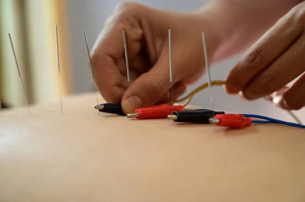 electroacupuncture efficace